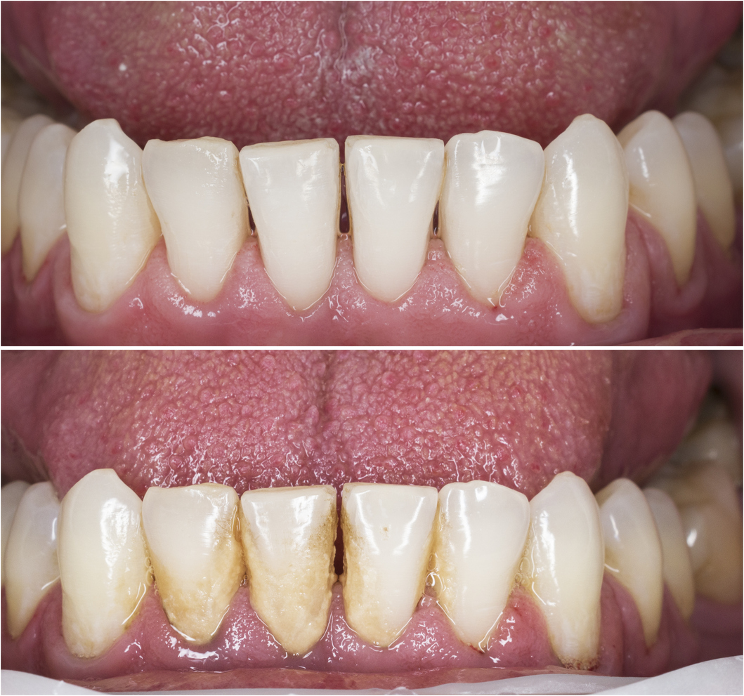 Teeth Whitening Lower Jaw