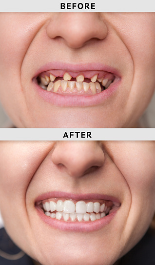 Are Dentures Necessary?